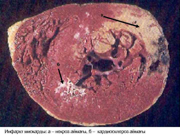 а б Инфаркт миокарды: а – некроз аймағы, б – кардиосклероз аймағы 