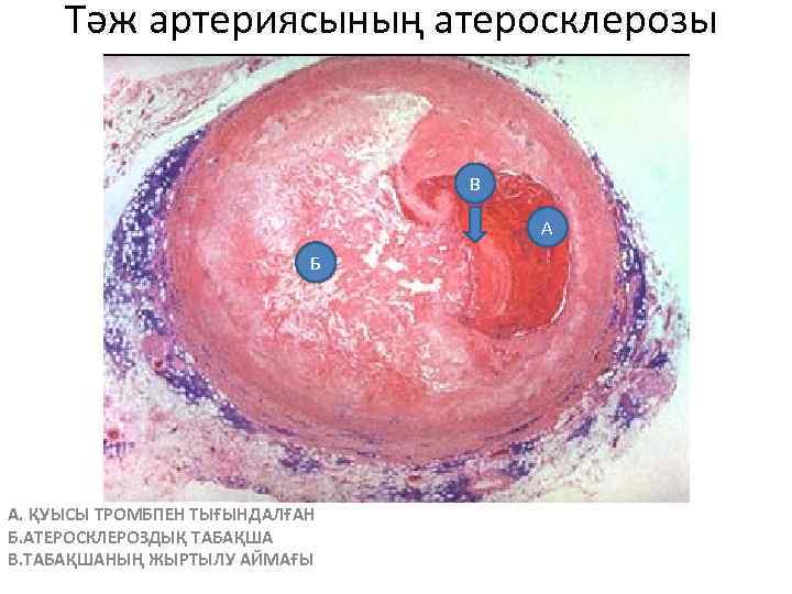 Тәж артериясының атеросклерозы В А Б А. ҚУЫСЫ ТРОМБПЕН ТЫҒЫНДАЛҒАН Б. АТЕРОСКЛЕРОЗДЫҚ ТАБАҚША В.