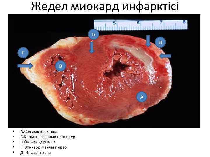 Жедел миокард инфарктісі Б Д Г В А • • • А. Сол жақ