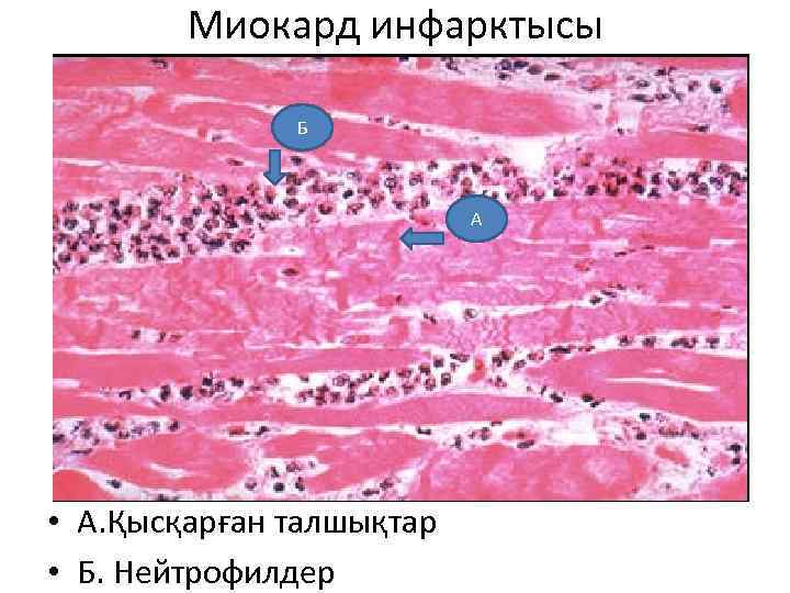 Миокард инфарктысы Б А • А. Қысқарған талшықтар • Б. Нейтрофилдер 