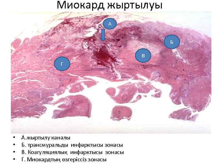 Миокард жыртылуы А Б В Г • • А. жыртылу каналы Б. трансмуральды инфарктысы