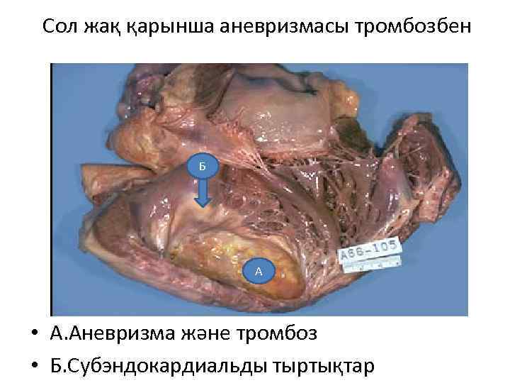 Сол жақ қарынша аневризмасы тромбозбен Б А • А. Аневризма және тромбоз • Б.