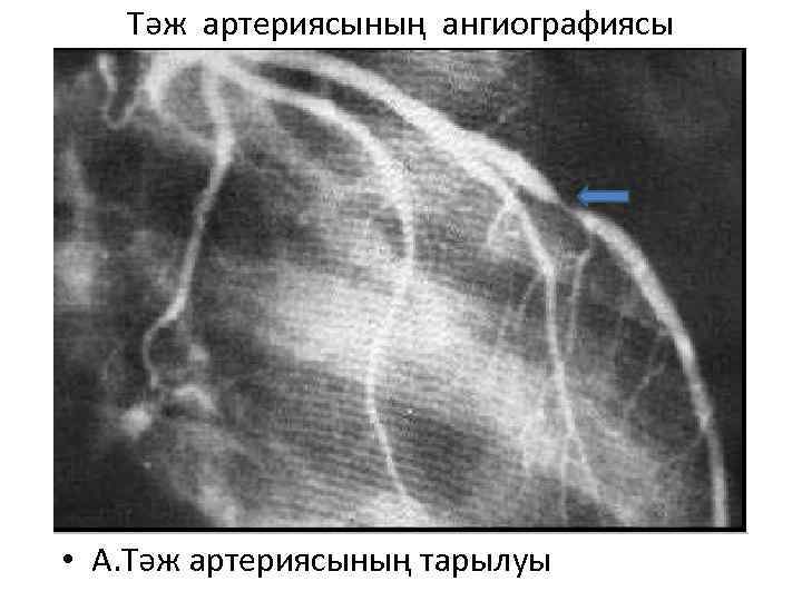 Тәж артериясының ангиографиясы • А. Тәж артериясының тарылуы 