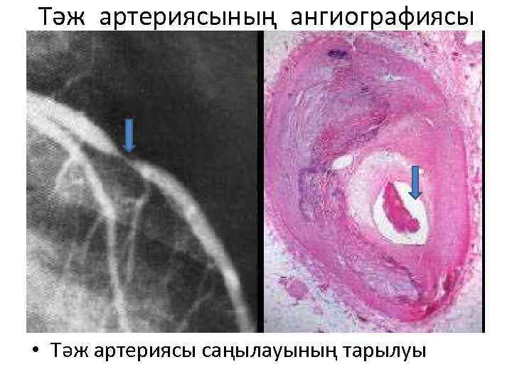 Тәж артериясының ангиографиясы • Тәж артериясы саңылауының тарылуы 