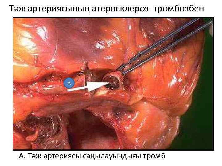 Тәж артериясының атеросклероз тромбозбен А А. Тәж артериясы саңылауындығы тромб 