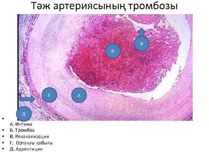 Тәж артериясының тромбозы В Б Г • • • Д А. Интима Б. Тромбоз