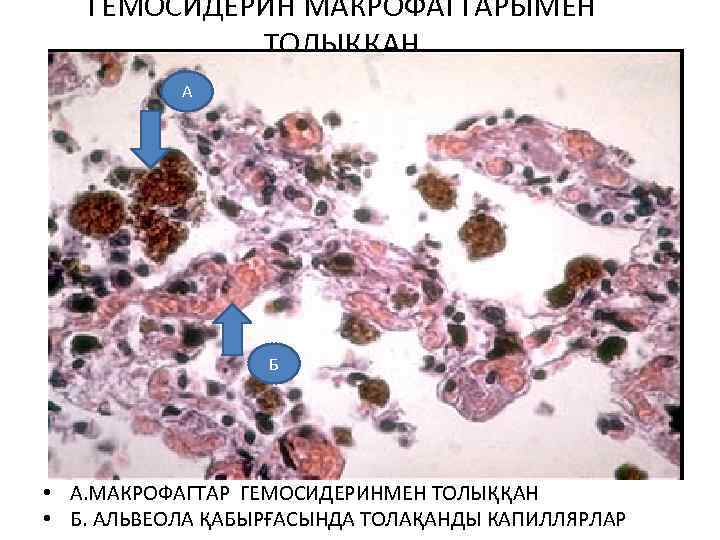 ГЕМОСИДЕРИН МАКРОФАГТАРЫМЕН ТОЛЫҚҚАН А Б • А. МАКРОФАГТАР ГЕМОСИДЕРИНМЕН ТОЛЫҚҚАН • Б. АЛЬВЕОЛА ҚАБЫРҒАСЫНДА