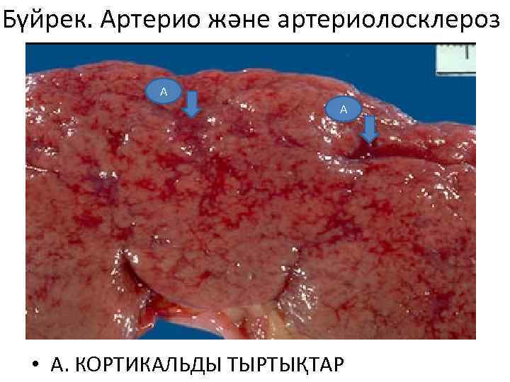 Бүйрек. Артерио және артериолосклероз А А • А. КОРТИКАЛЬДЫ ТЫРТЫҚТАР 