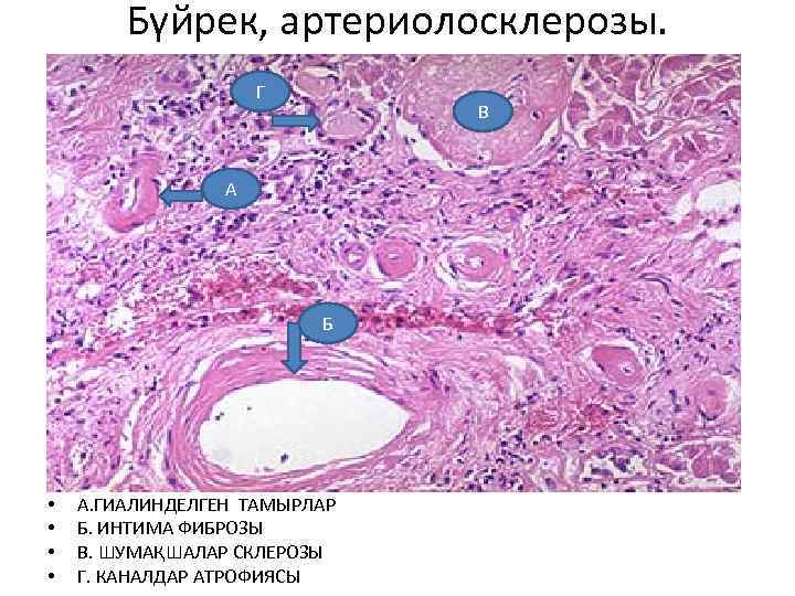 Бүйрек, артериолосклерозы. Г В А Б • • А. ГИАЛИНДЕЛГЕН ТАМЫРЛАР Б. ИНТИМА ФИБРОЗЫ