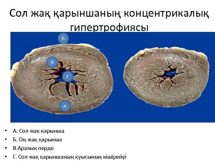 Сол жақ қарыншаның концентрикалық гипертрофиясы Б В Г А • • А. Сол жақ