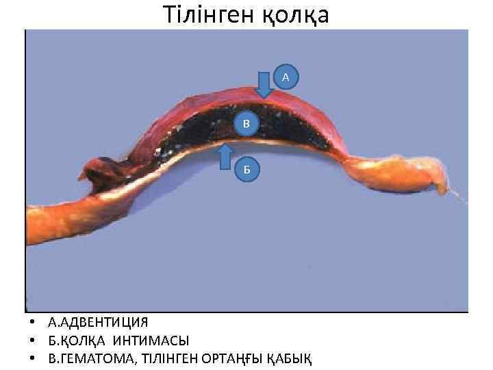 Тілінген қолқа А В Б • А. АДВЕНТИЦИЯ • Б. ҚОЛҚА ИНТИМАСЫ • В.