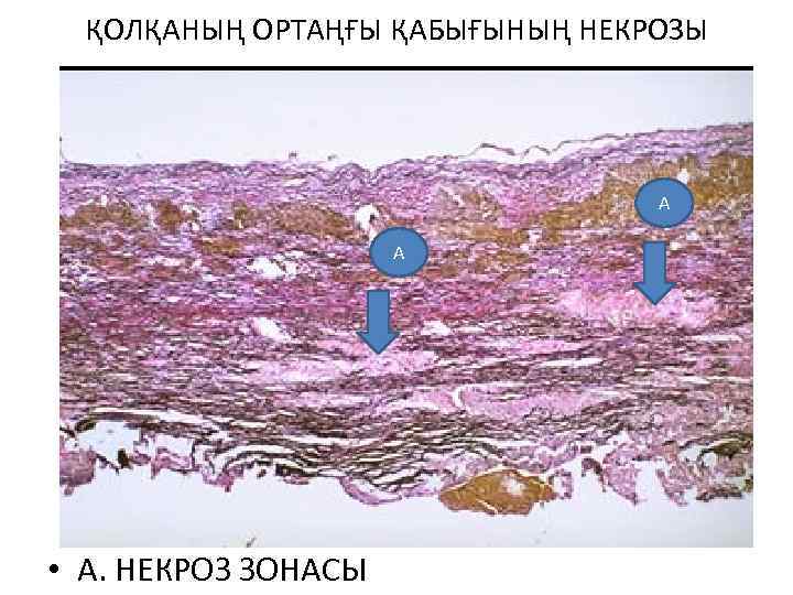 ҚОЛҚАНЫҢ ОРТАҢҒЫ ҚАБЫҒЫНЫҢ НЕКРОЗЫ А А • А. НЕКРОЗ ЗОНАСЫ 