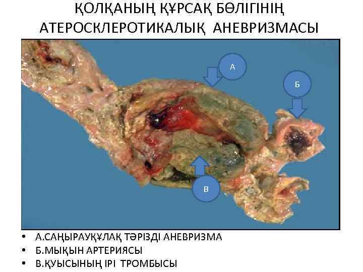 ҚОЛҚАНЫҢ ҚҰРСАҚ БӨЛІГІНІҢ АТЕРОСКЛЕРОТИКАЛЫҚ АНЕВРИЗМАСЫ А Б В • А. САҢЫРАУҚҰЛАҚ ТӘРІЗДІ АНЕВРИЗМА •