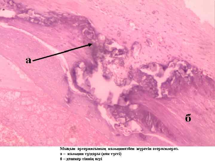 Мықын артериясының кальцинозбен жүретін атеросклероз. а – кальции тұздары (көк түсті) б – дәнекер