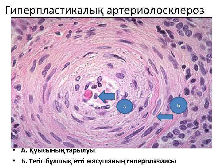 Гиперпластикалық артериолосклероз А • А. Қуысының тарылуы • Б. Тегіс бұлшық етті жасушаның гиперплазиясы