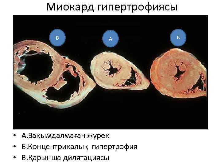  Миокард гипертрофиясы В А • А. Зақымдалмаған жүрек • Б. Концентрикалық гипертрофия •