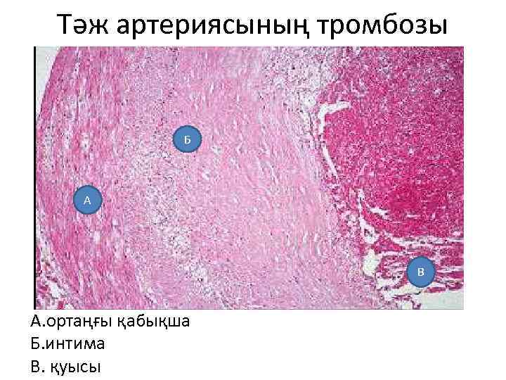 Тәж артериясының тромбозы Б А В А. ортаңғы қабықша Б. интима В. қуысы 