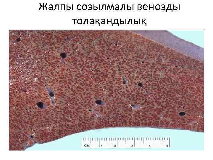 Жалпы созылмалы венозды толақандылық 