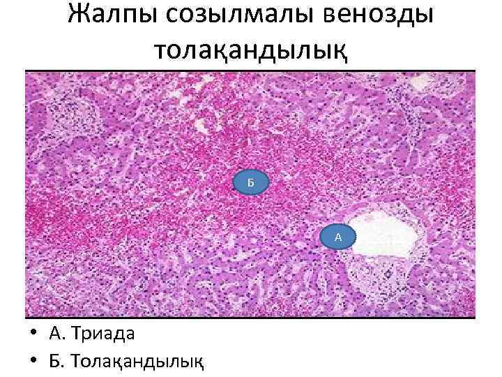 Жалпы созылмалы венозды толақандылық Б А • А. Триада • Б. Толақандылық 