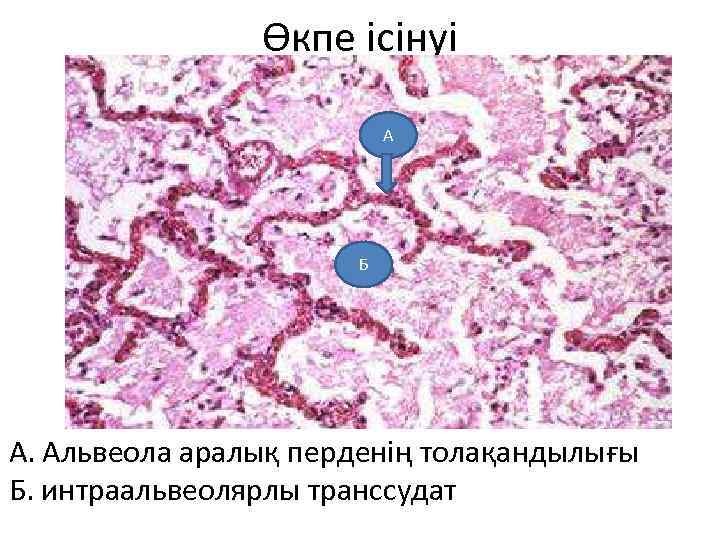 Өкпе ісінуі А Б А. Альвеола аралық перденің толақандылығы Б. интраальвеолярлы транссудат 