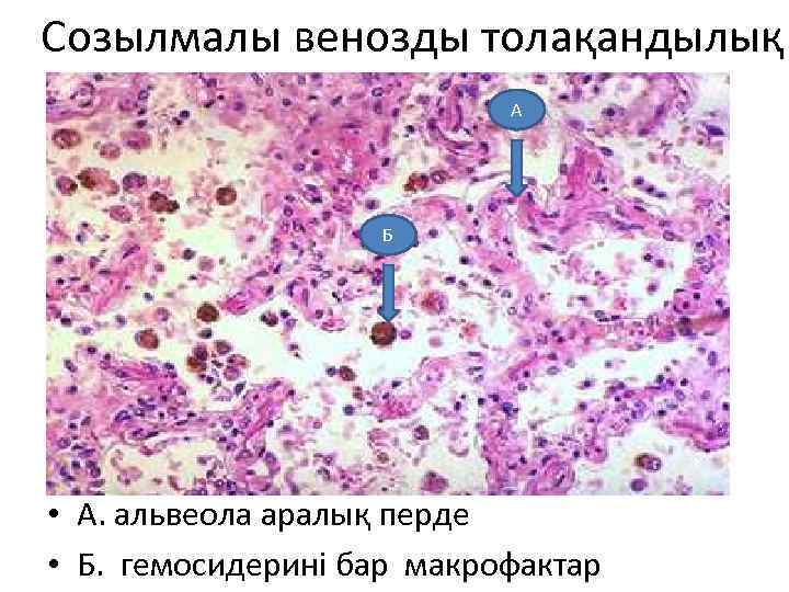 Созылмалы венозды толақандылық А Б • А. альвеола аралық перде • Б. гемосидерині бар