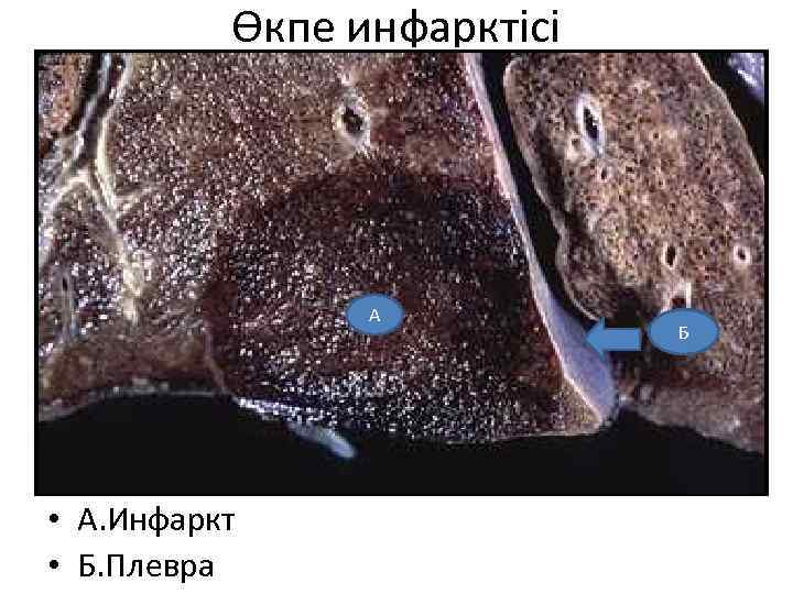 Өкпе инфарктісі А • А. Инфаркт • Б. Плевра Б 