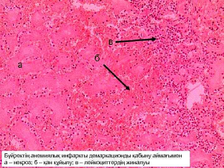 Бүйректің анемиялық почки с зоной демаркационного воспаления Анемический инфаркты демаркационды қабыну аймағымен а –