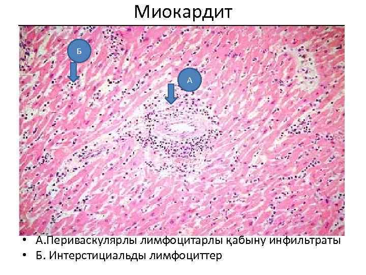 Миокардит Б А • А. Периваскулярлы лимфоцитарлы қабыну инфильтраты • Б. Интерстициальды лимфоциттер 