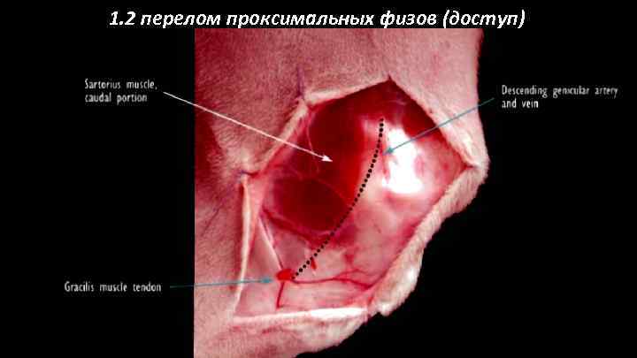 1. 2 перелом проксимальных физов (доступ)) 