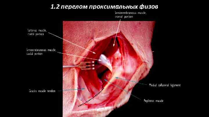 1. 2 перелом проксимальных физов 