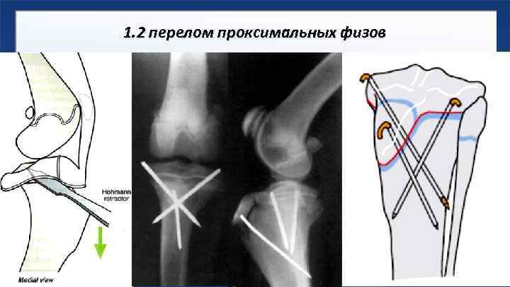 1. 2 перелом проксимальных физов 