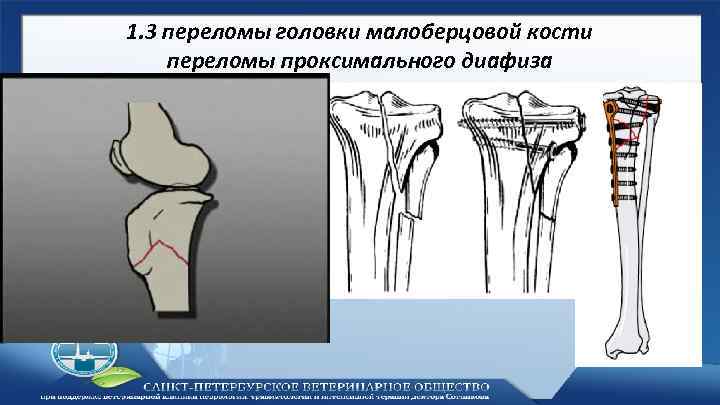 Диафизарные переломы костей голени презентация