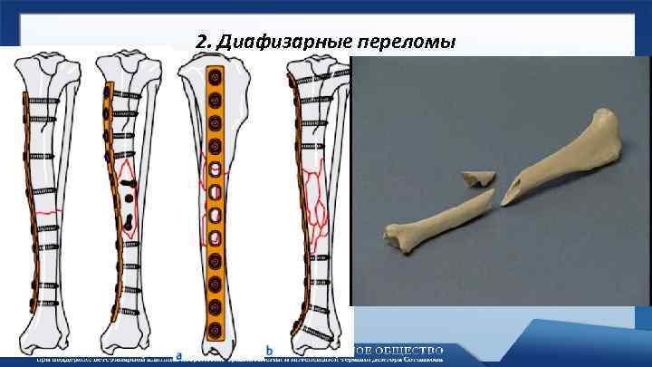 2. Диафизарные переломы 