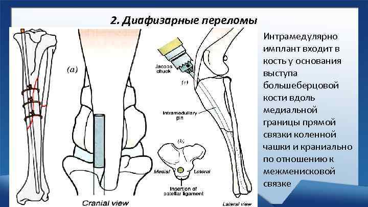 2. Диафизарные переломы Интрамедулярно имплант входит в кость у основания выступа большеберцовой кости вдоль