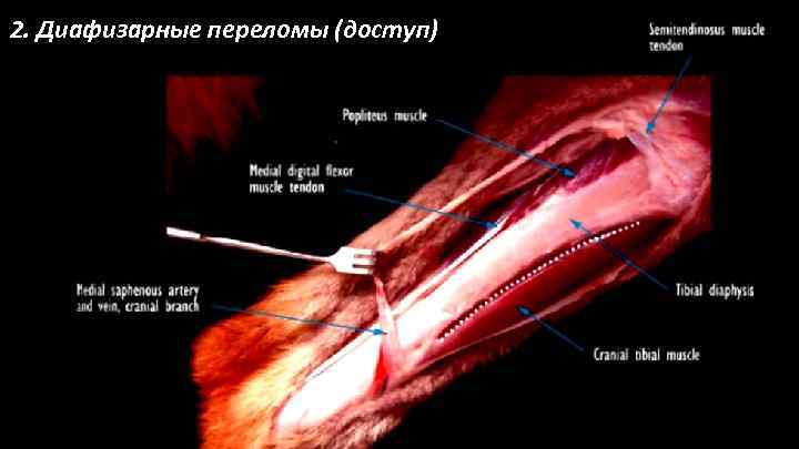 2. Диафизарные переломы (доступ) 