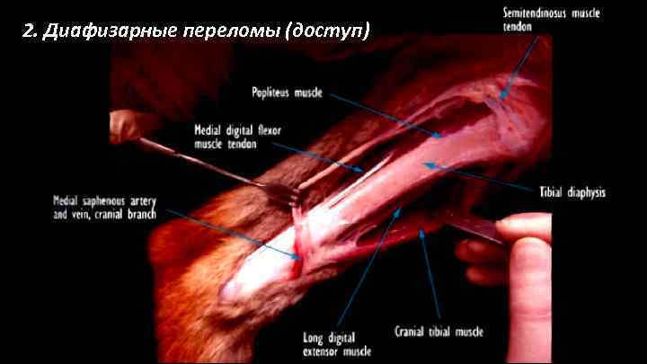 2. Диафизарные переломы (доступ) 