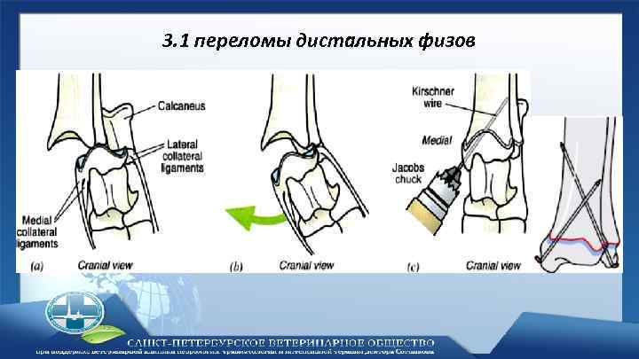 3. 1 переломы дистальных физов 