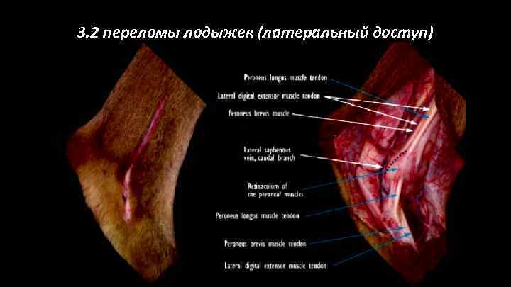 3. 2 переломы лодыжек (латеральный доступ) 