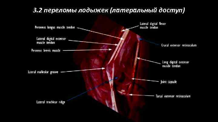 3. 2 переломы лодыжек (латеральный доступ) 