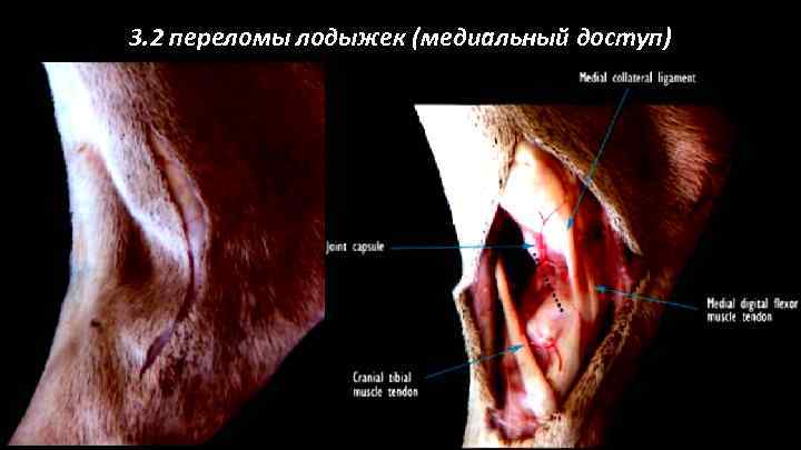 3. 2 переломы лодыжек (медиальный доступ) 