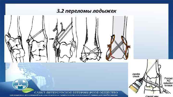 3. 2 переломы лодыжек 