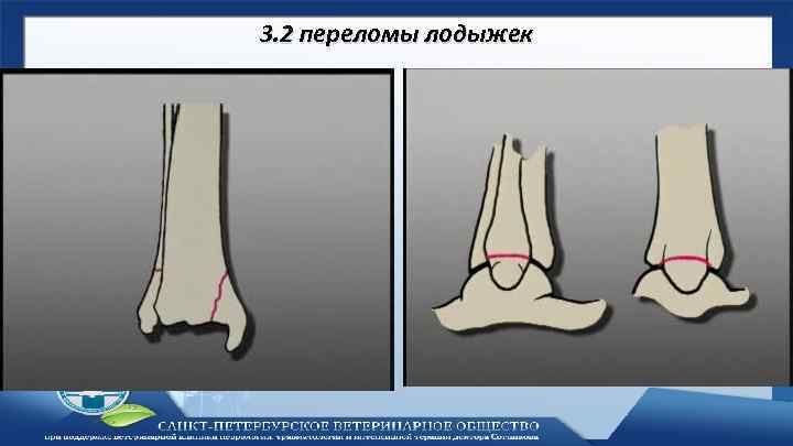 3. 2 переломы лодыжек 