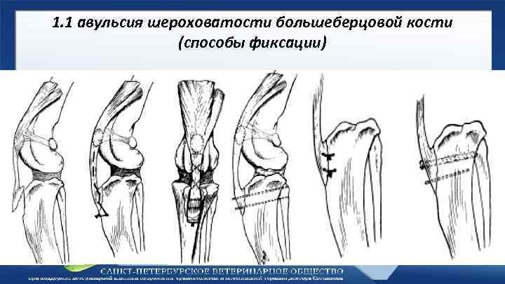 1. 1 авульсия шероховатости большеберцовой кости (способы фиксации) 