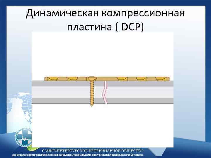 Динамическая компрессионная пластина ( DCP) 