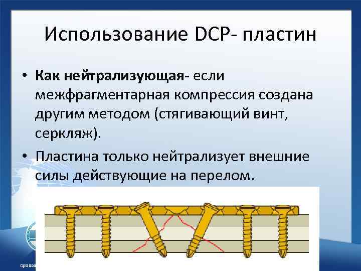 Использование DCP- пластин • Как нейтрализующая- если межфрагментарная компрессия создана другим методом (стягивающий винт,