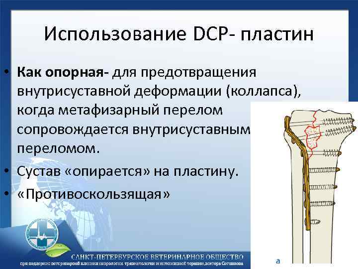 Использование DCP- пластин • Как опорная- для предотвращения внутрисуставной деформации (коллапса), когда метафизарный перелом