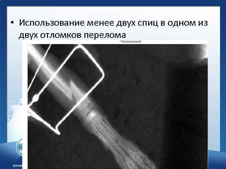  • Использование менее двух спиц в одном из двух отломков перелома 