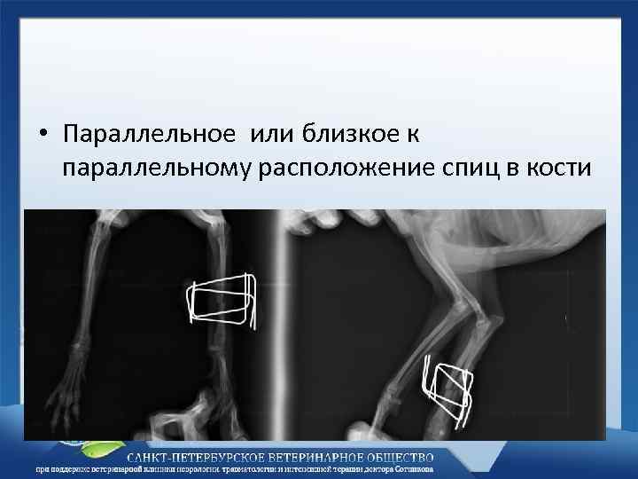  • Параллельное или близкое к параллельному расположение спиц в кости 