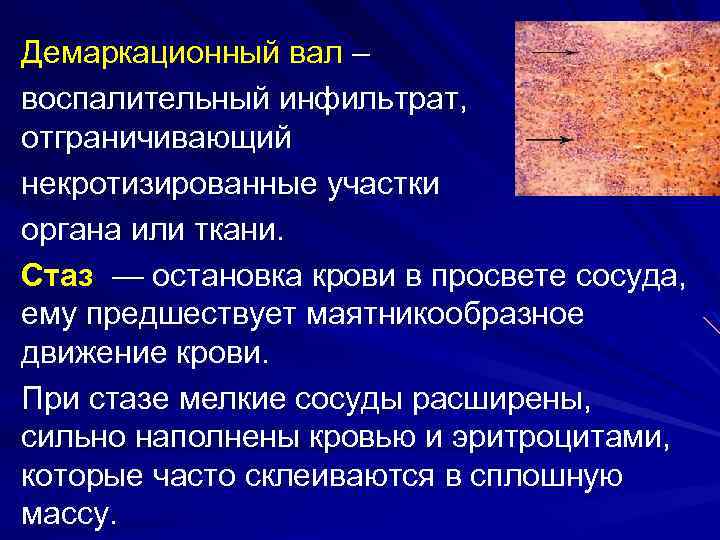 Демаркационный вал – воспалительный инфильтрат, отграничивающий некротизированные участки органа или ткани. Стаз — остановка