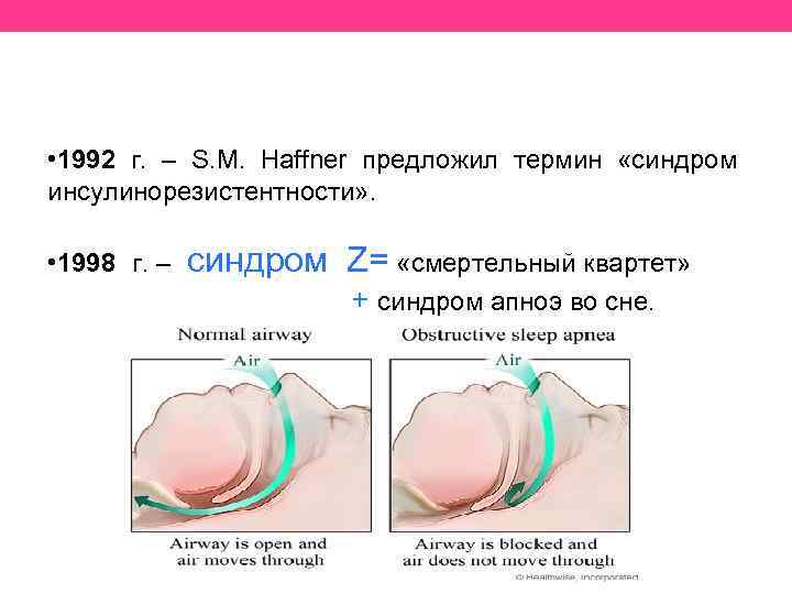  • 1992 г. – S. M. Haffner предложил термин «синдром инсулинорезистентности» . •